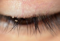 Глазные, или ресничные клещи: кто они, по каким причинам появляются, какие симптомы свидетельствуют о них, и какие есть методы лечения