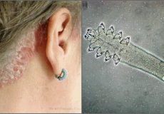Причины появления и симптомы ушного клеща у человека и эффективные методы борьбы с ним